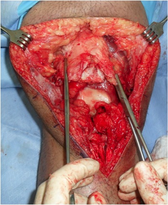 Chronic Patella Tendon Rupture 1